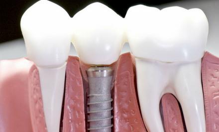 implant-biotech-armavir-dent