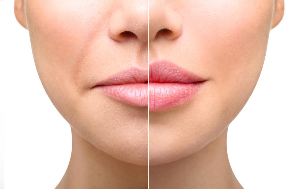 shurteri-filler-hills-beauty-center