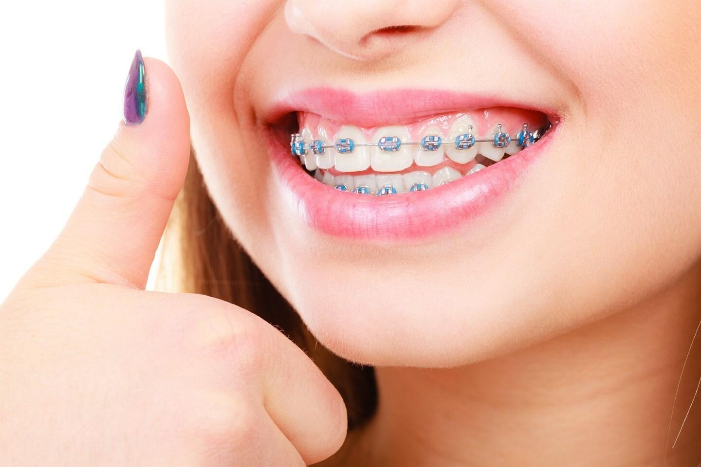 atamnashari-uxxum-breket-aparatayin-bujum-yerevan-dental-art