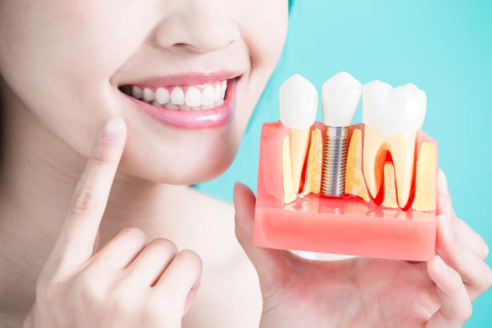 dental-implantation-modern-implant-medicine