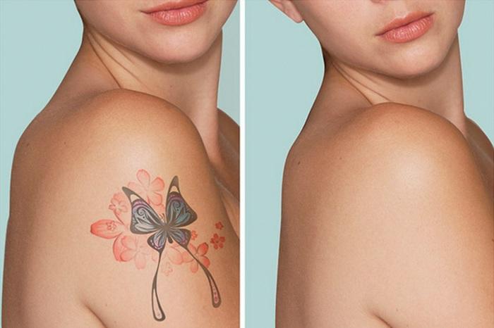 ar-style-tattoo-removal
